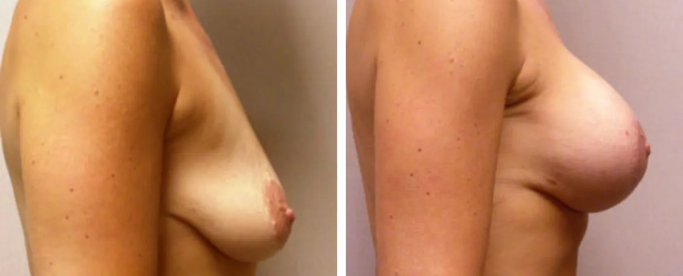 Breast Augmentation with Lollipop Lift c