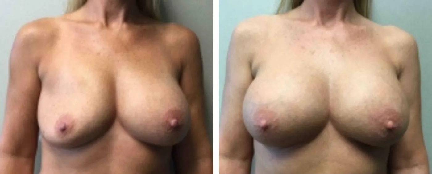Breast Implant Removal and Replacement in Michigan a