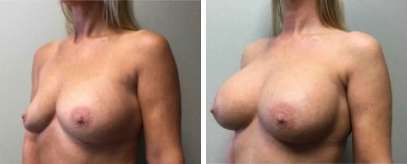 Breast Implant Removal and Replacement in Michigan b