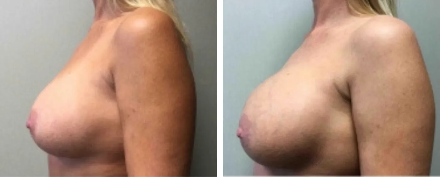 Breast Implant Removal and Replacement in Michigan c