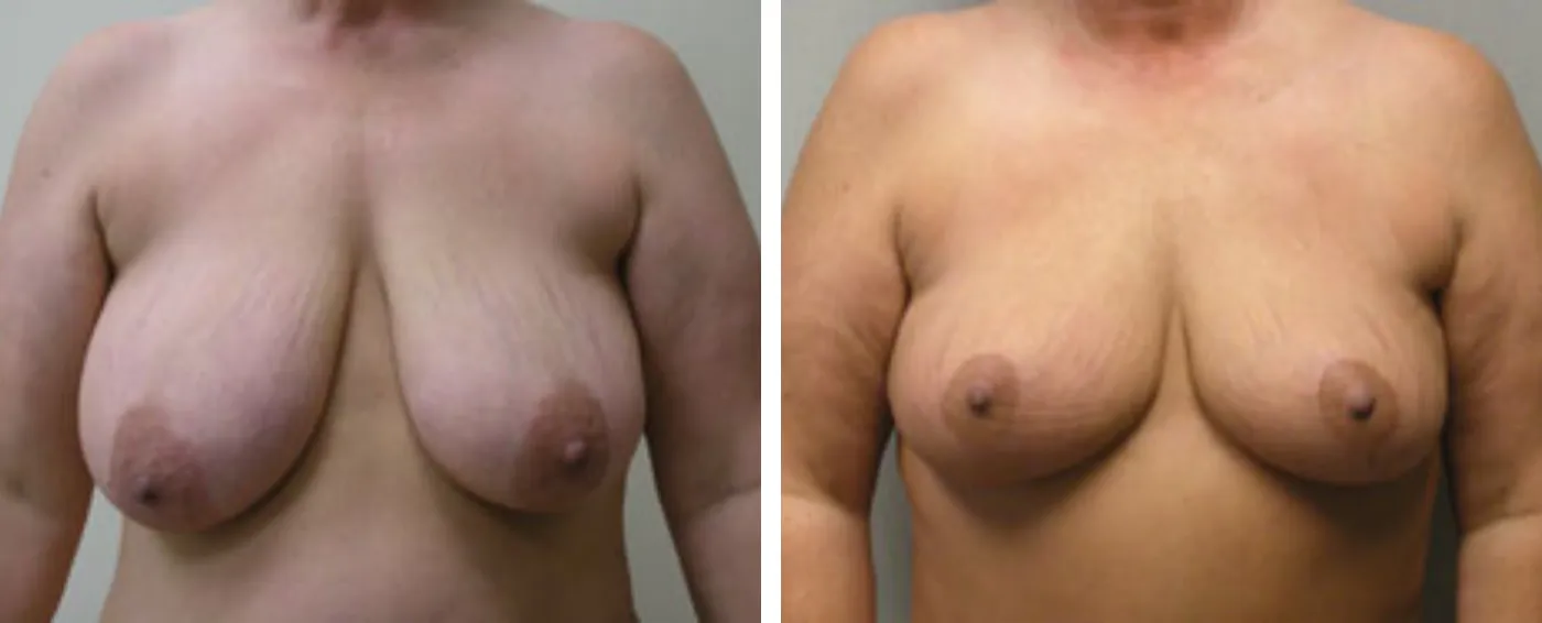 Breast lift A