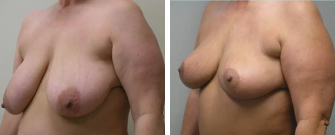 Breast lift B
