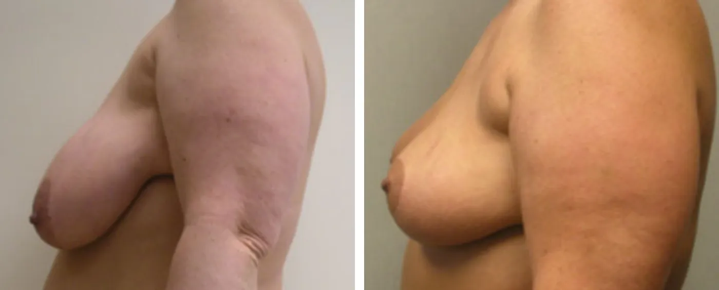 Breast lift C