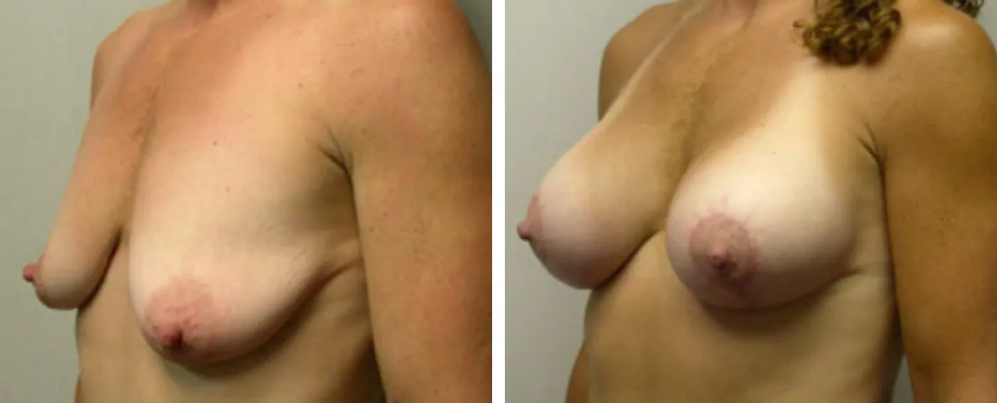 Breast Augmentation with Lollipop Lift b