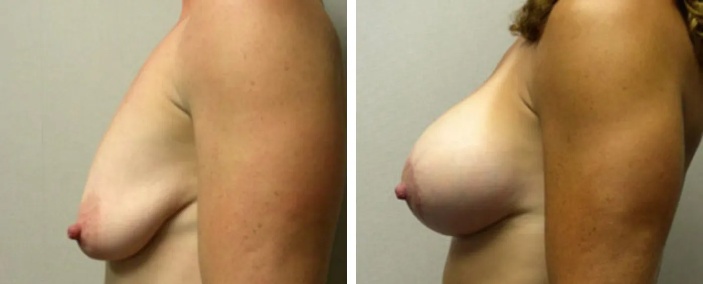 Breast Augmentation with Lollipop Lift c