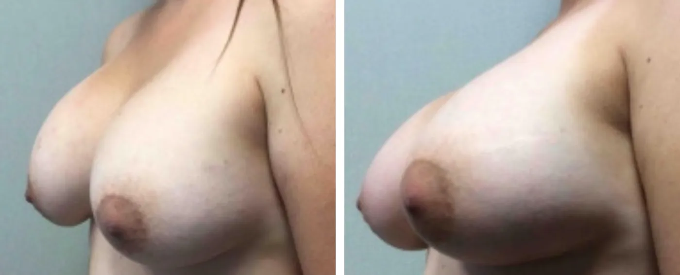 Breast Implant Removal and Replacement in Michigan b