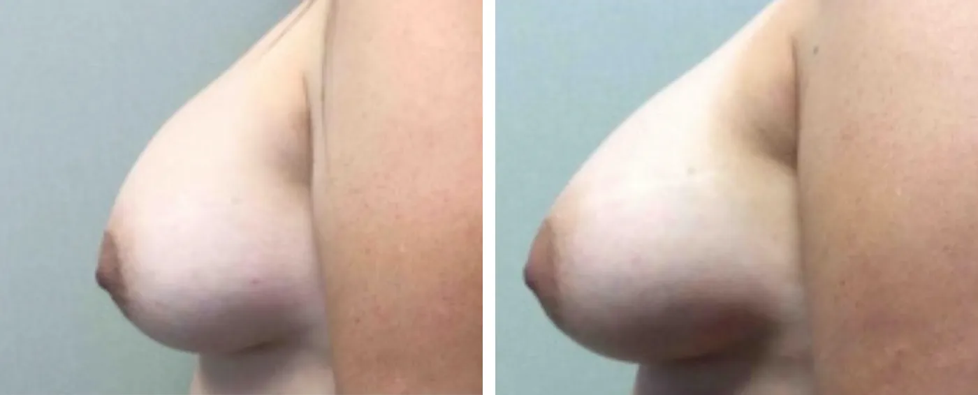 Breast Implant Removal and Replacement in Michigan c