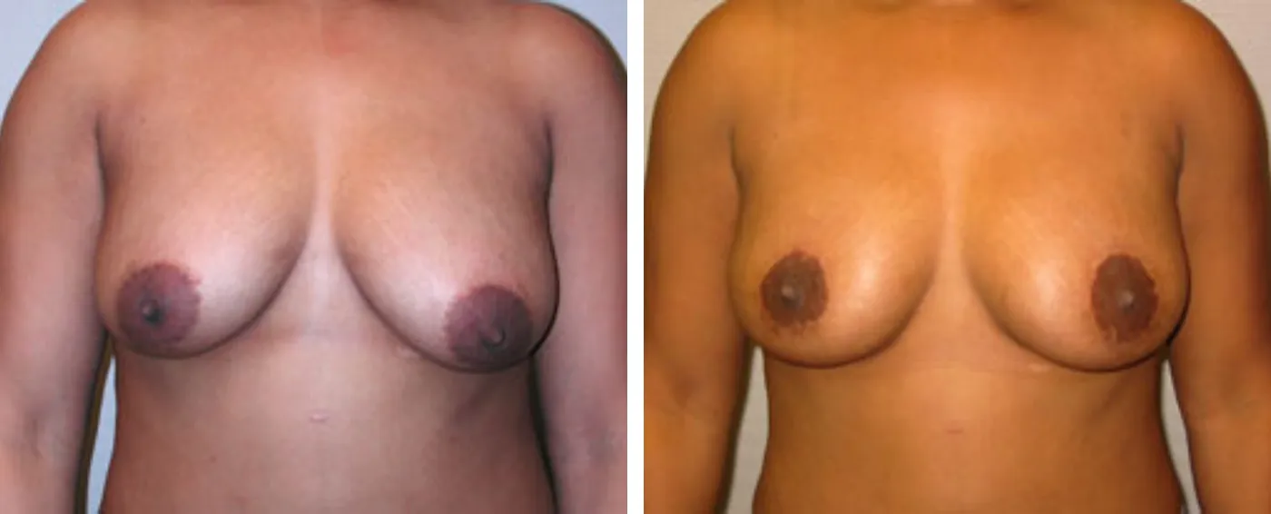 Breast lift a
