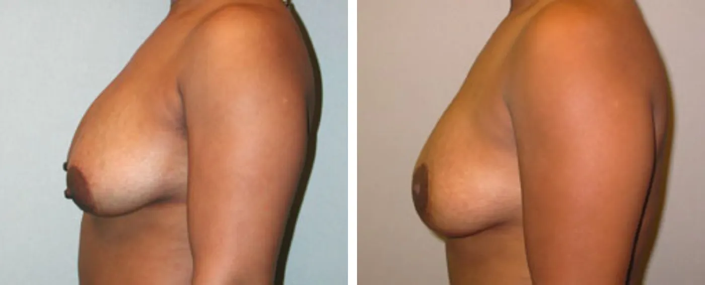 Breast lift c