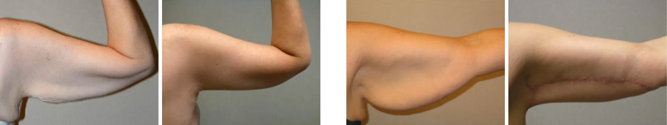 Best Arm Lift In Michgian ()