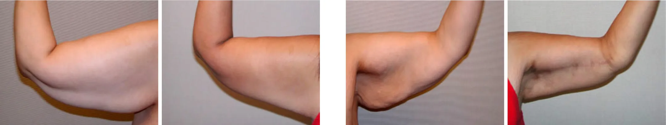 Best Arm Lift In Michgian ()