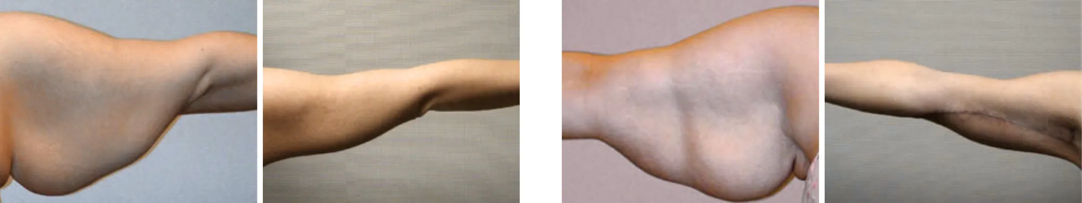 Best Arm Lift In Michgian ()