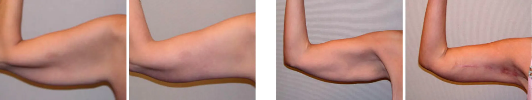 Best Arm Lift In Michgian