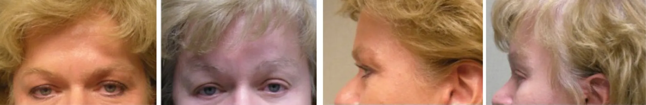 Best Brow Lift In Michigan ()