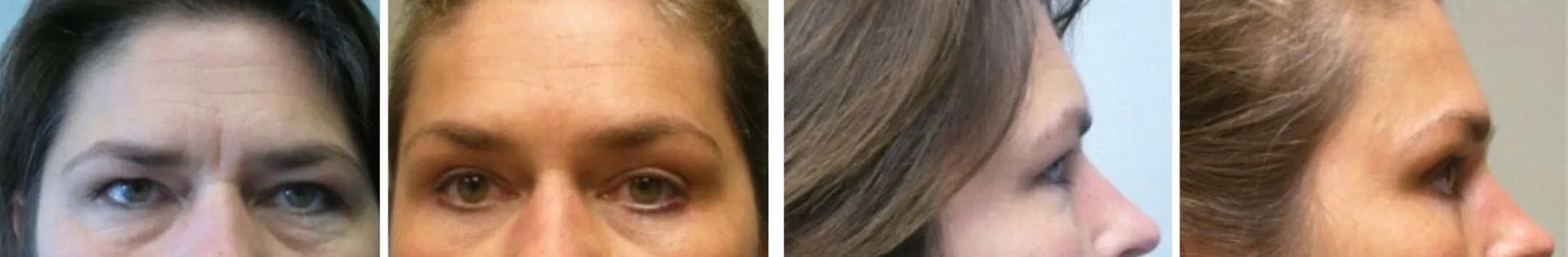 Best Brow Lift In Michigan ()