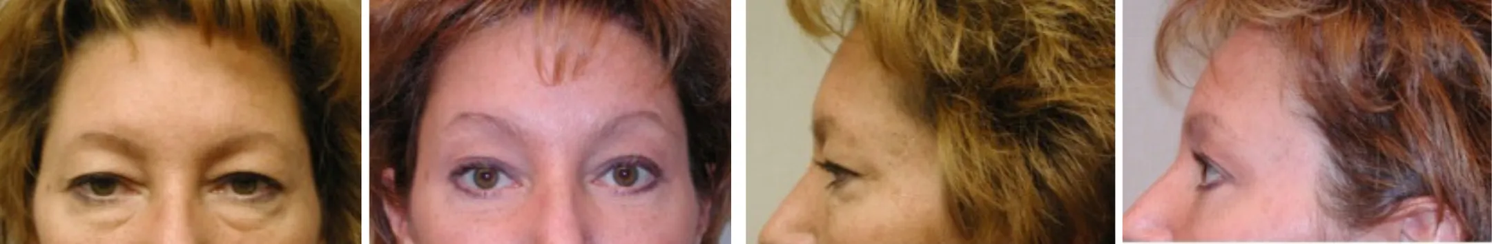 Best Brow Lift In Michigan ()