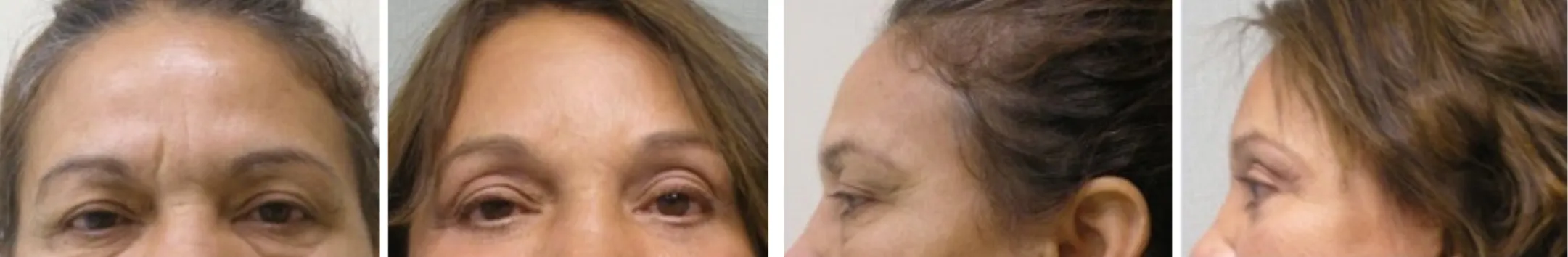 Best Brow Lift In Michigan ()