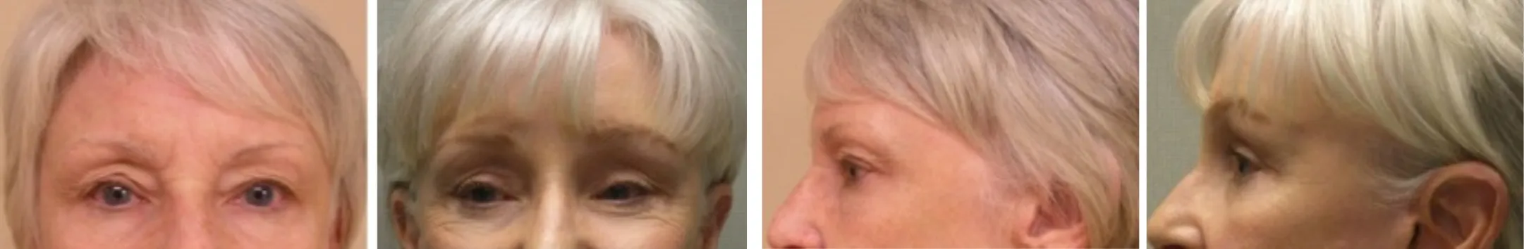 Best Brow Lift In Michigan ()