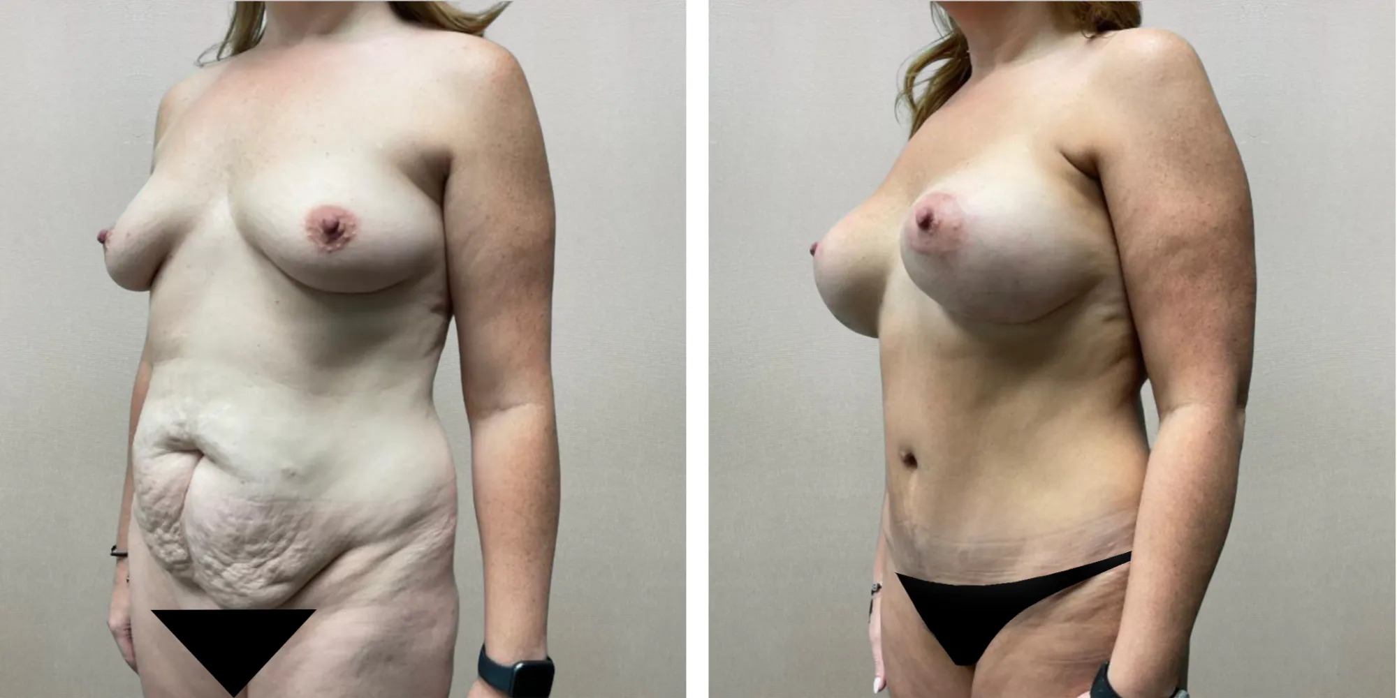 Best Mommy Makeover in Birmingham Michigan ()