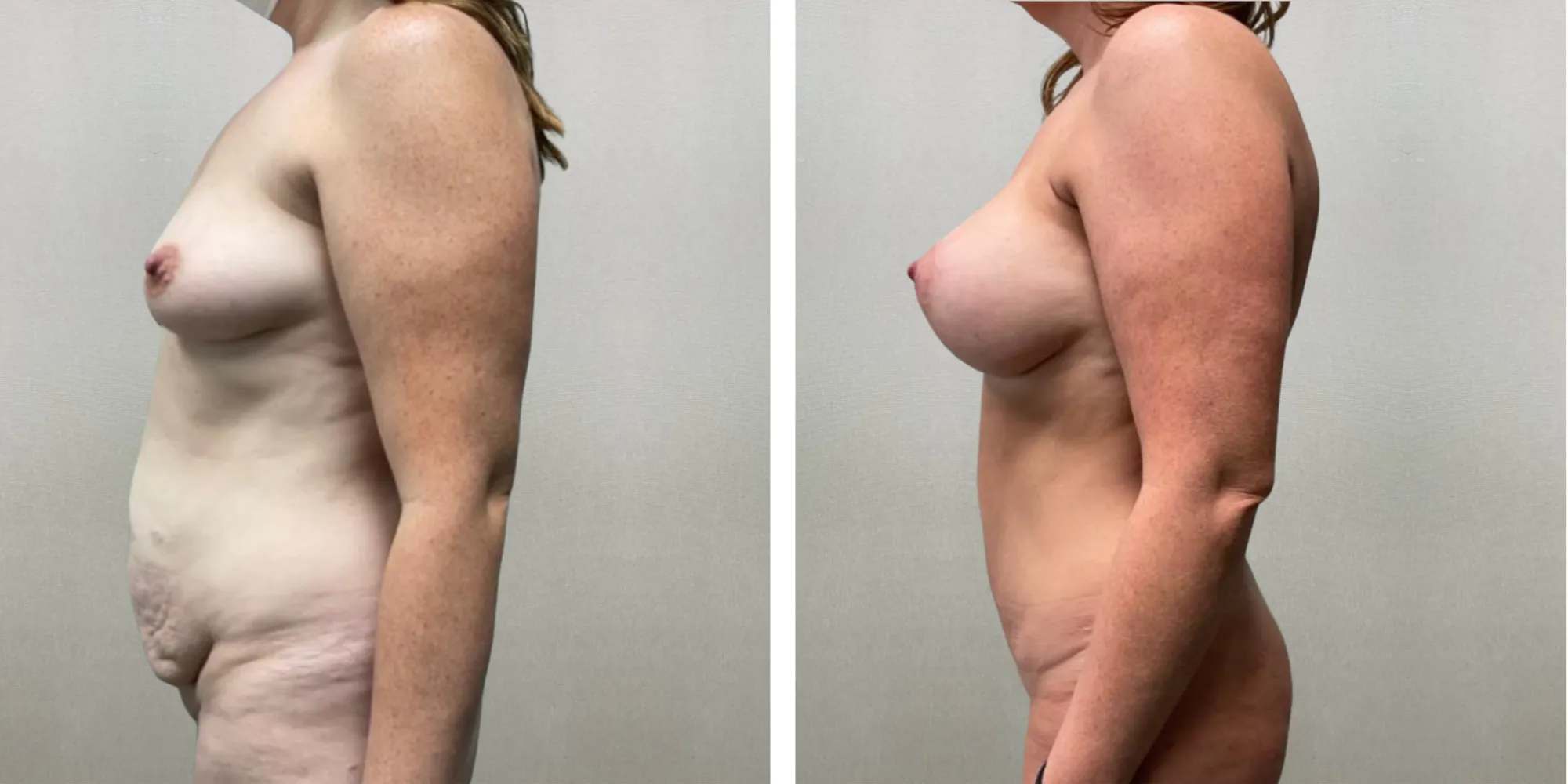 Best Mommy Makeover in Birmingham Michigan ()