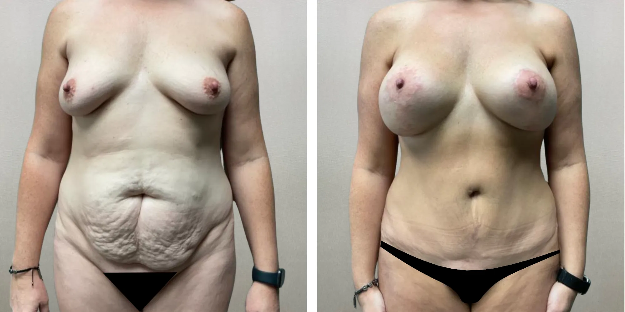 Best Mommy Makeover in Birmingham Michigan