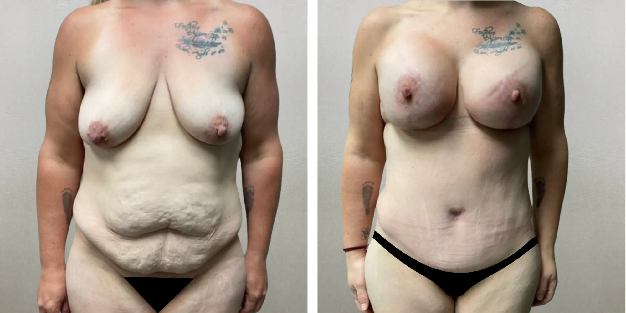 Best Mommy Makeover in Michigan