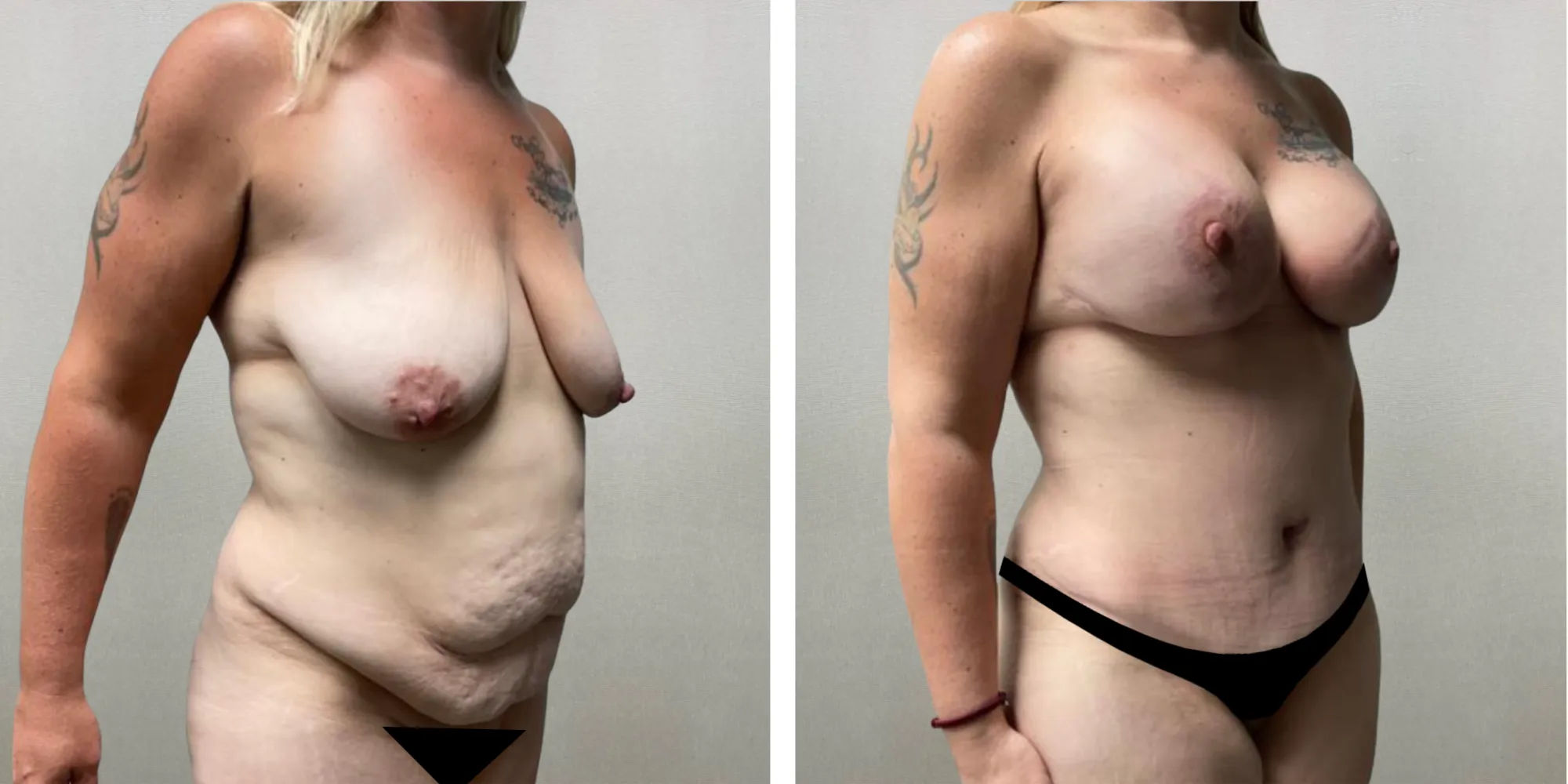 Best Mommy Makeover in Michigan ()