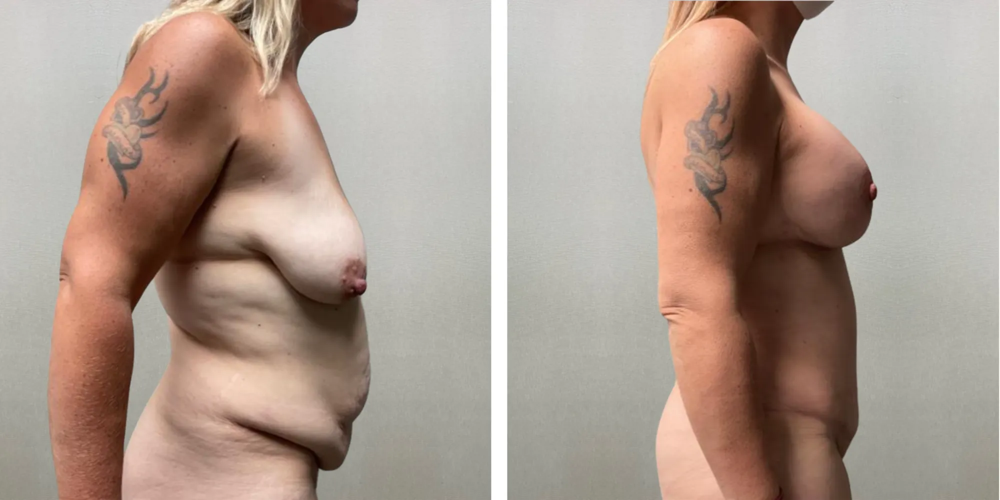 Best Mommy Makeover in Michigan ()