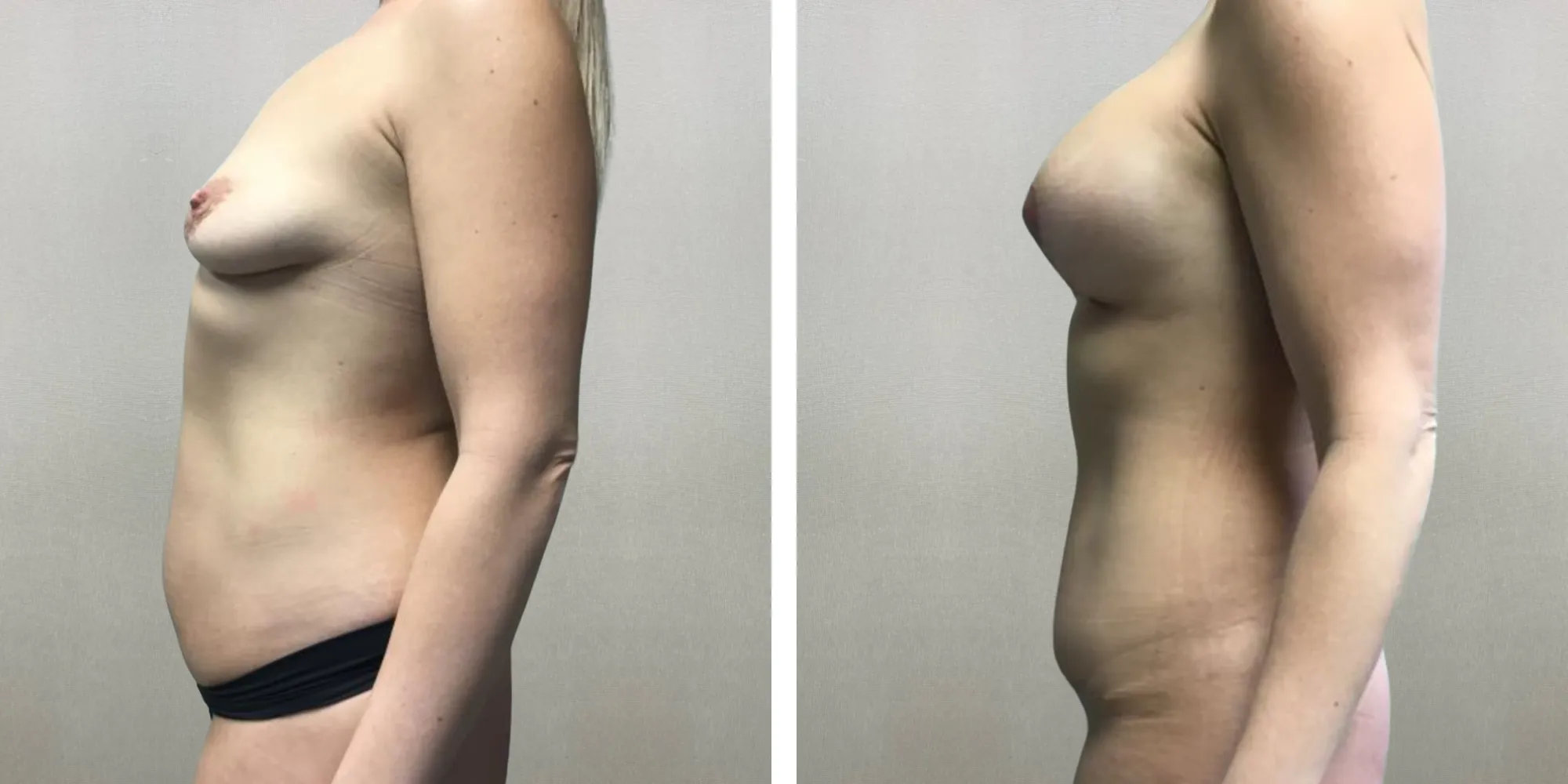 Best Mommy Makeover in Michigan ()