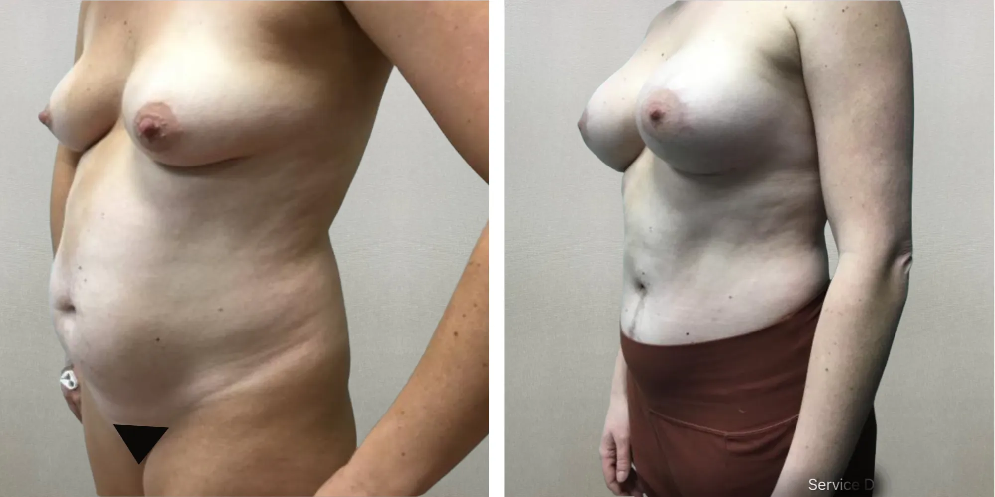 Best Mommy Makeover in Midwest ()