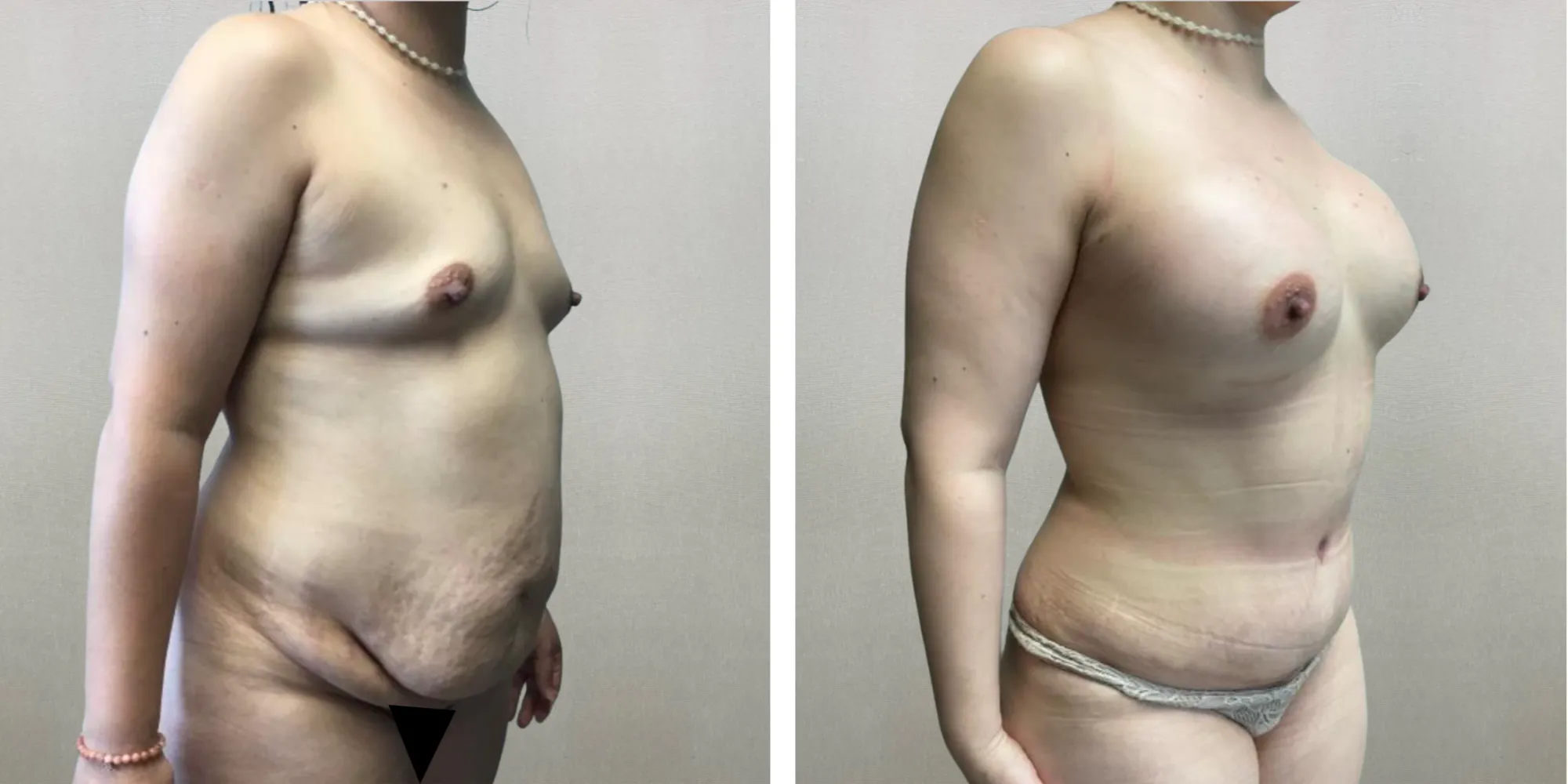 Best Mommy Makeover in Soutfield Michigan ()