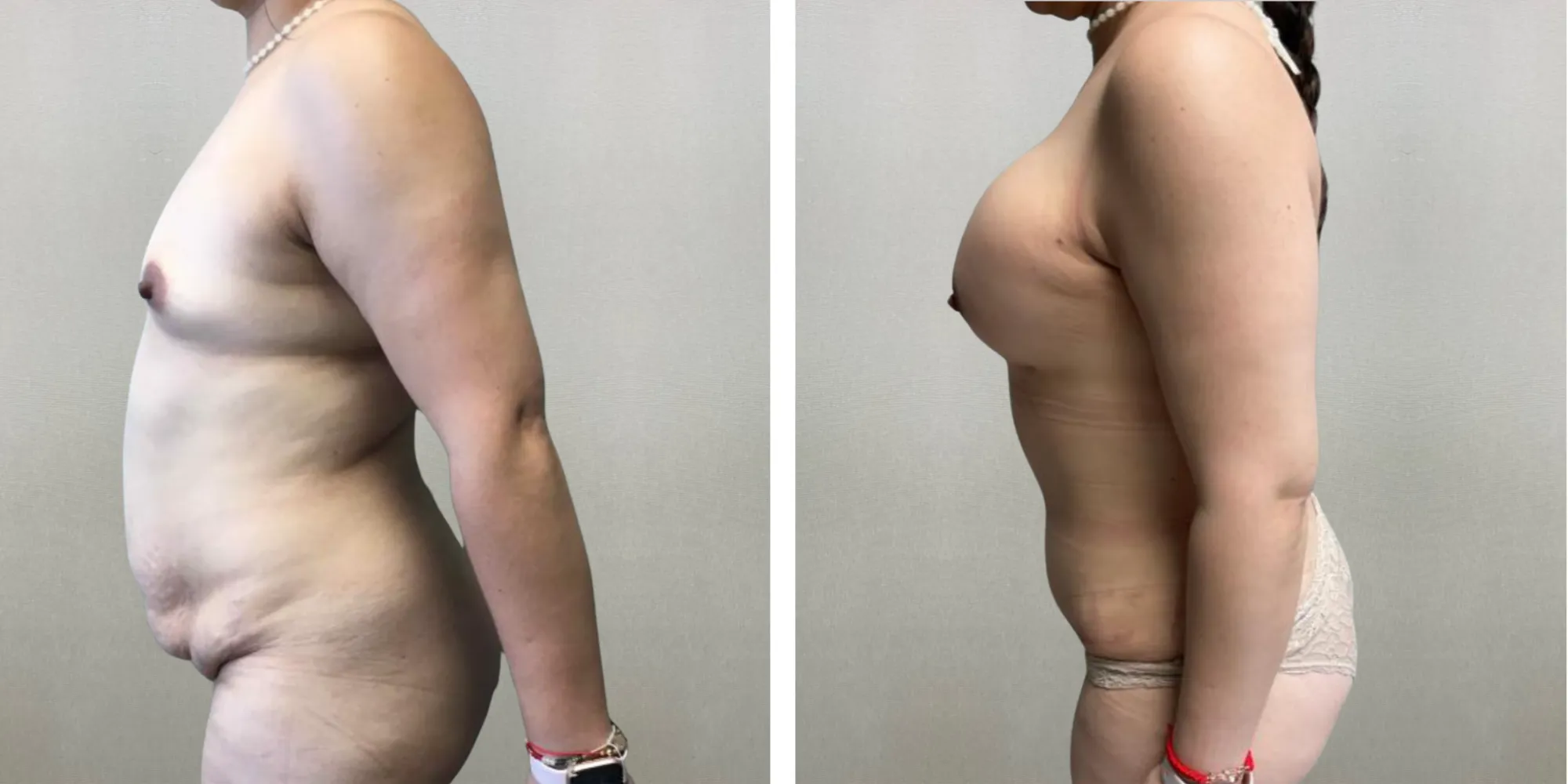 Best Mommy Makeover in Soutfield Michigan ()