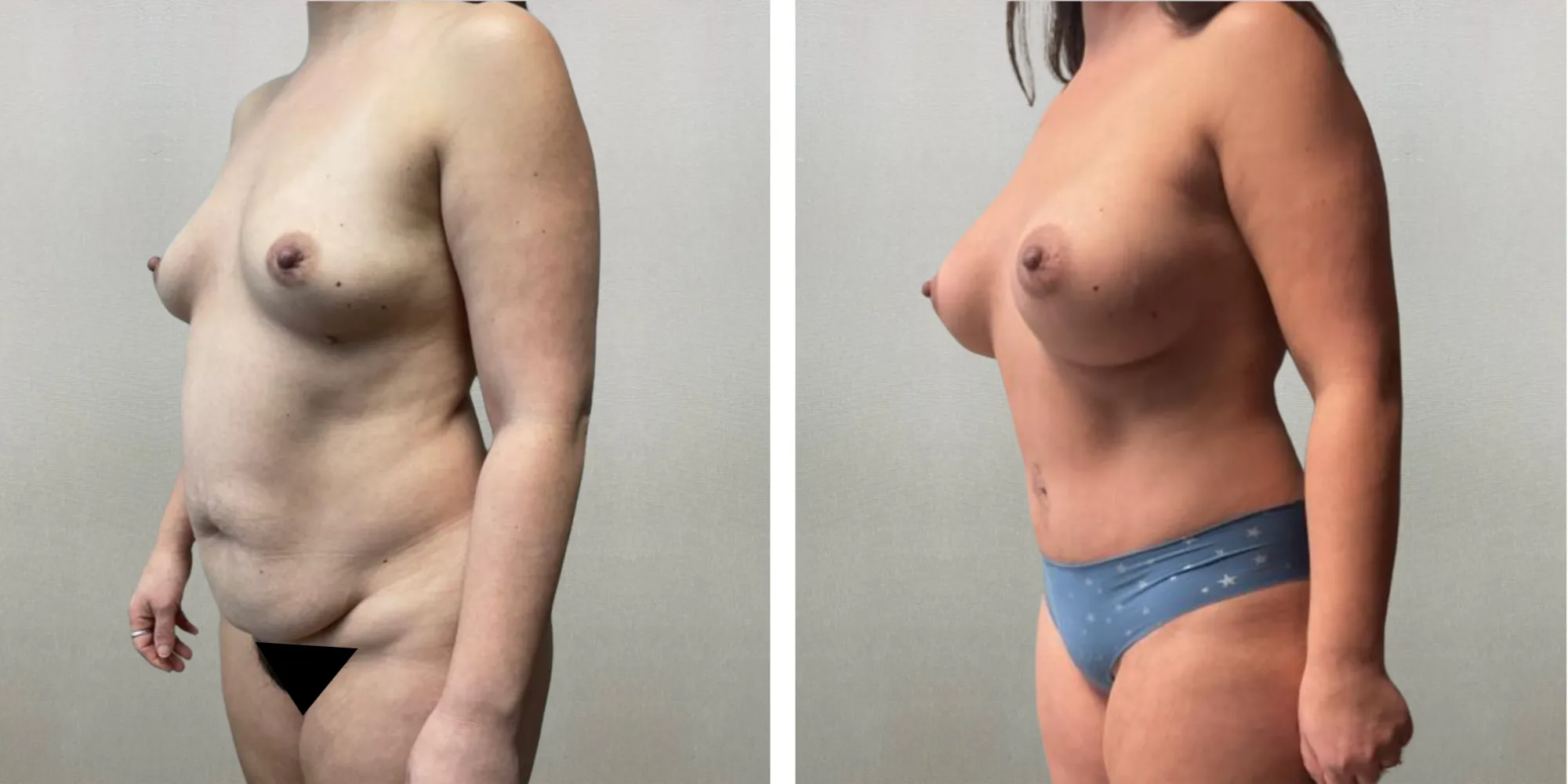 Best Mommy Makeover in Troy Michigan ()