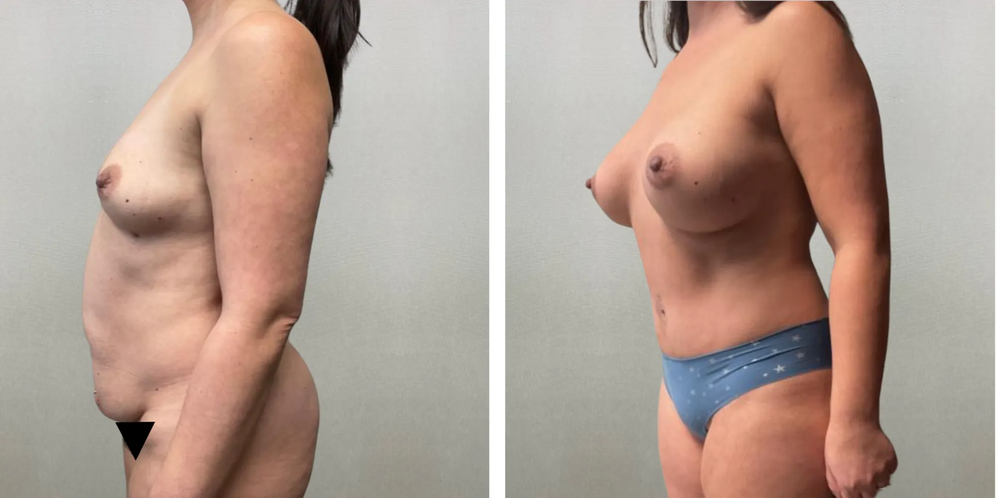 Best Mommy Makeover in Troy Michigan ()