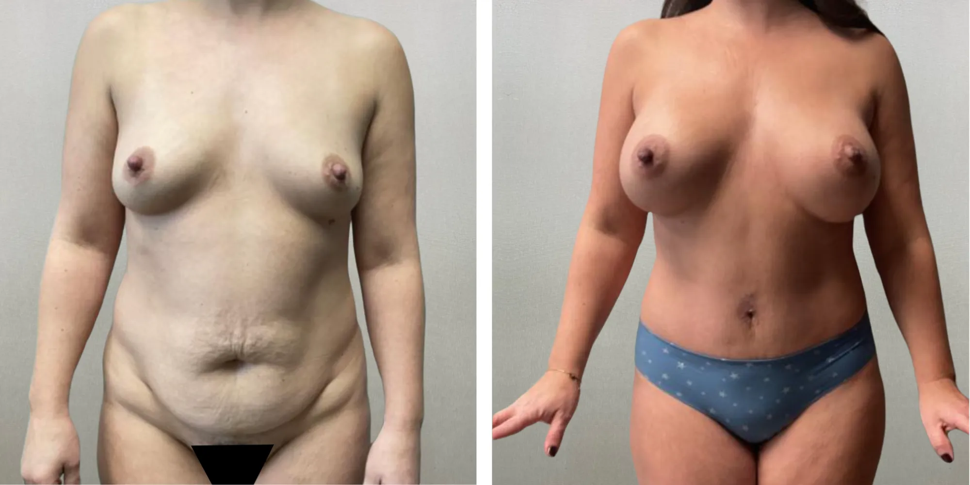 Best Mommy Makeover in Troy Michigan