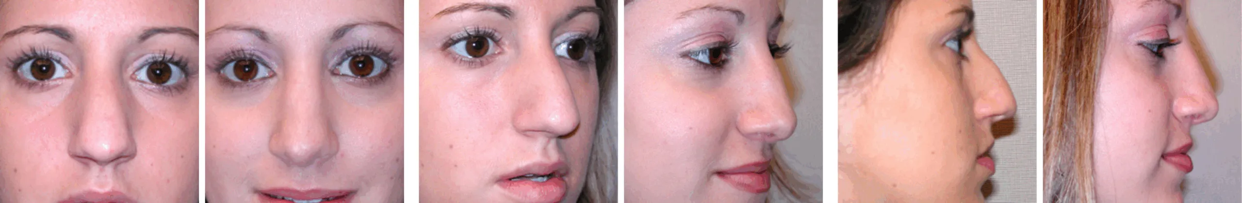 Best Rhinoplasty in Michigan ()