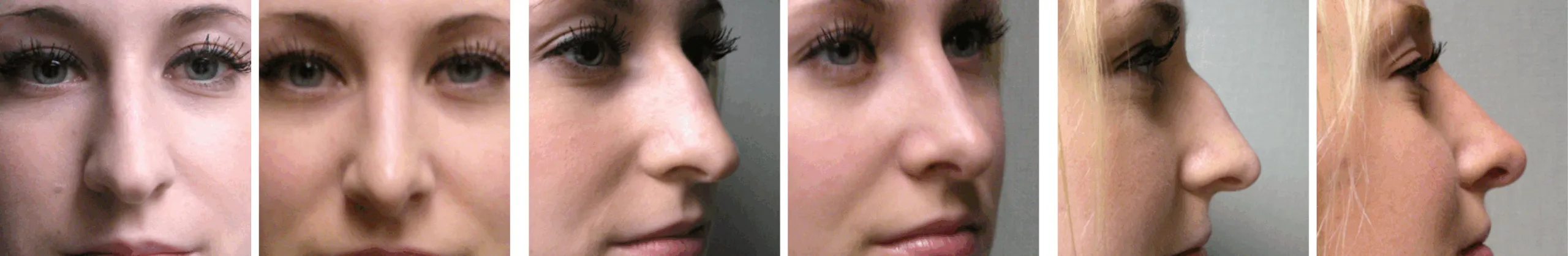 Best Rhinoplasty in Michigan ()