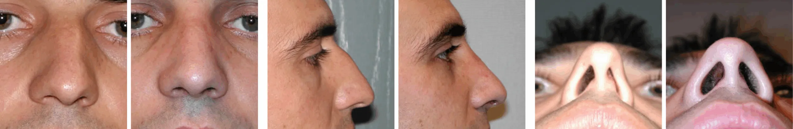 Best Rhinoplasty in Michigan ()
