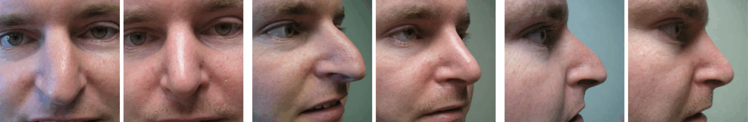 Best Rhinoplasty in Michigan ()