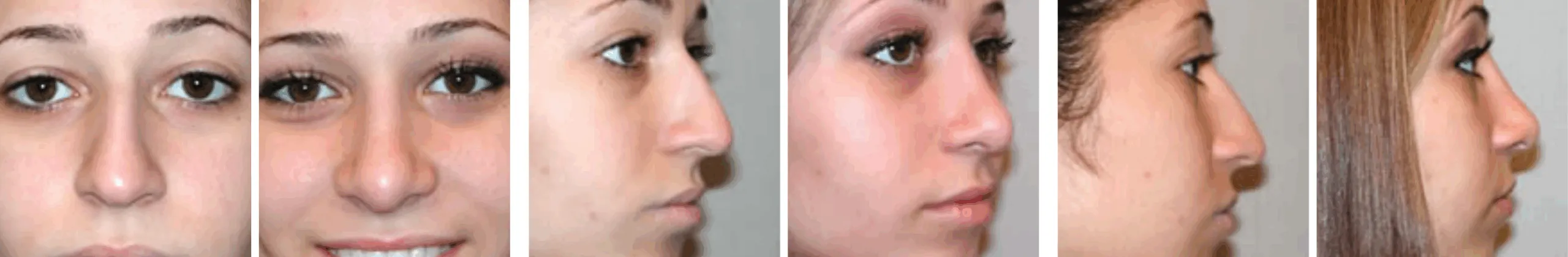 Best Rhinoplasty in Michigan ()