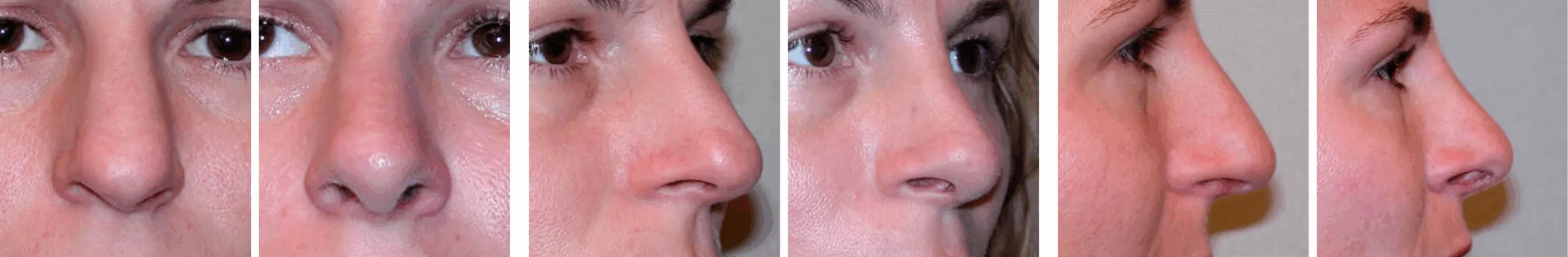 Best Rhinoplasty in Michigan ()
