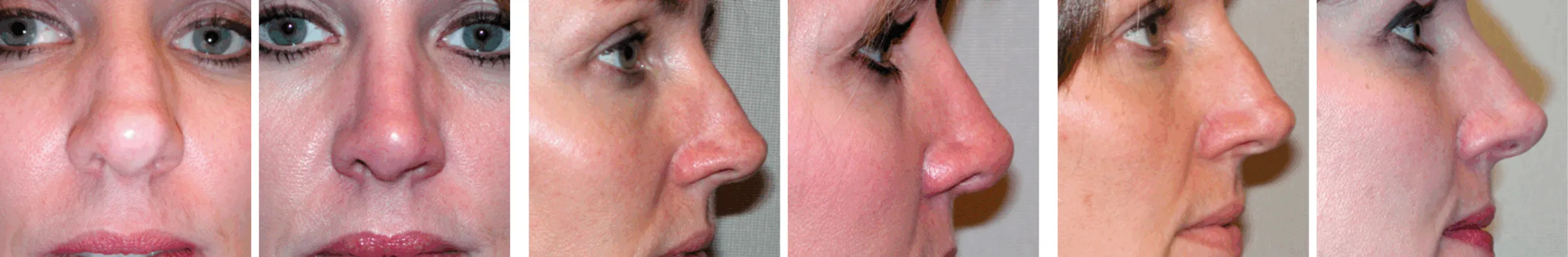 Best Rhinoplasty in Michigan ()
