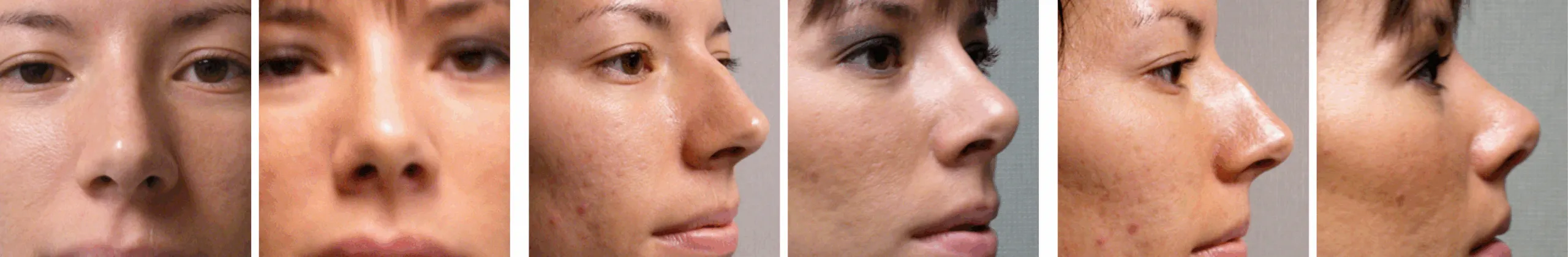 Best Rhinoplasty in Michigan ()