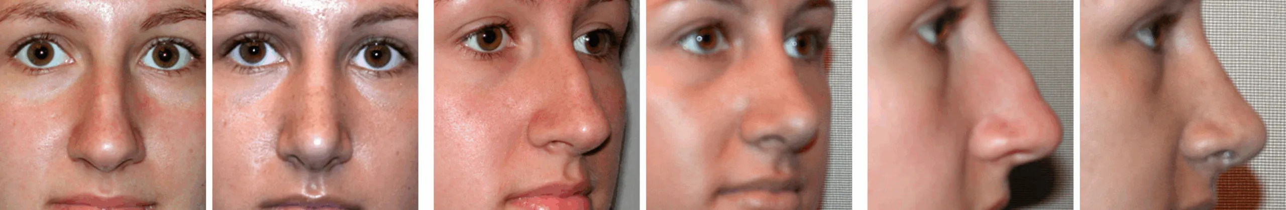 Best Rhinoplasty in Michigan ()