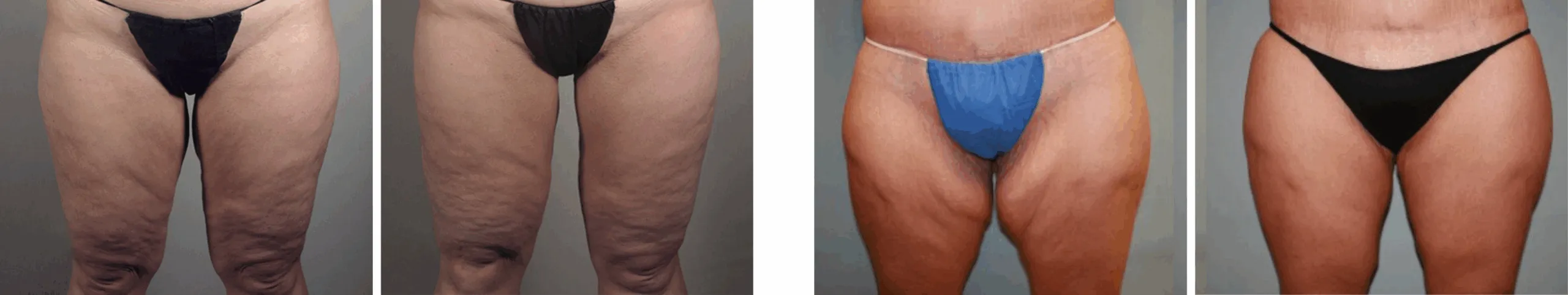 Best Thigh Lift In Michgian ()