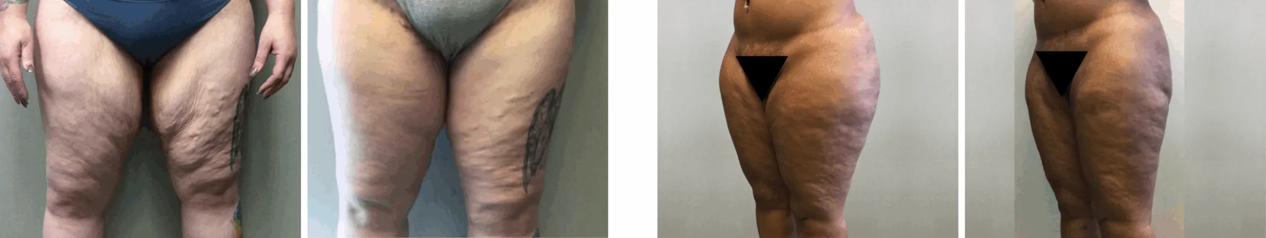 Best Thigh Lift In Michgian ()