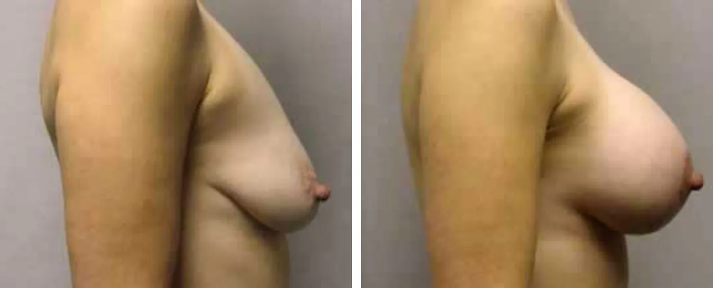 Breast Augmentation with Lollipop Lift c