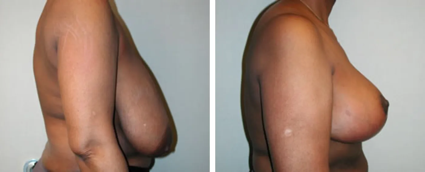 Breast Reduction C