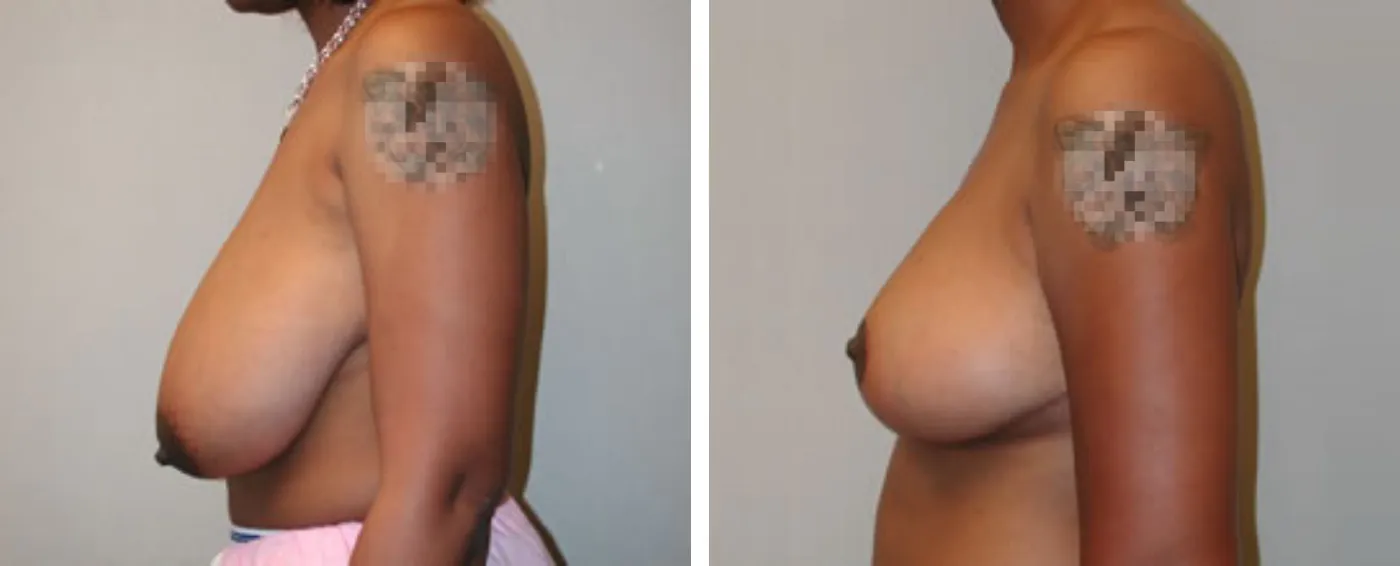Breast Reduction C