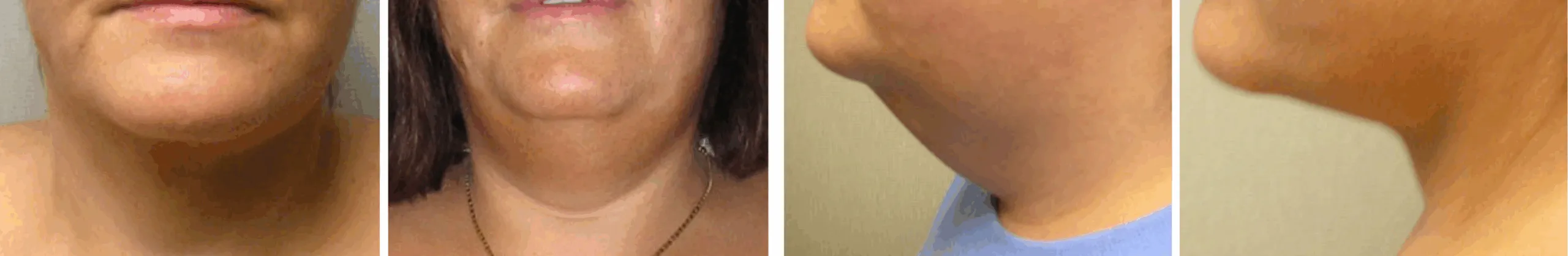 Chin Lipo In Michigan ()
